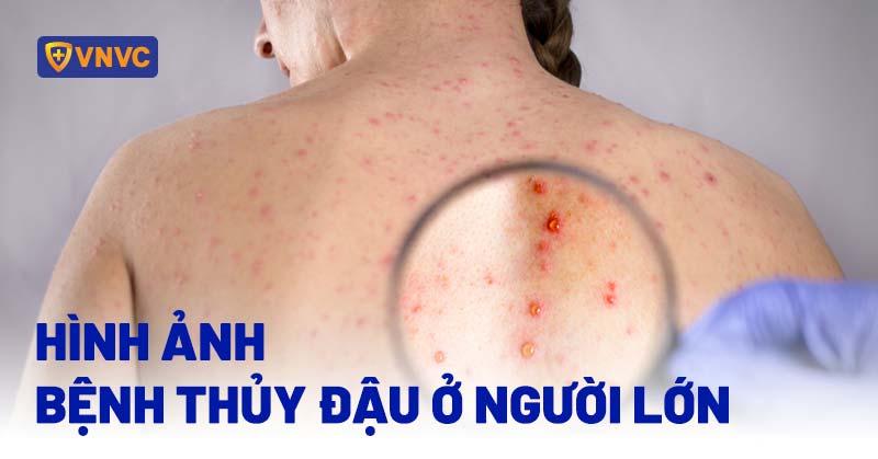 Triệu chứng thủy đậu ở người lớn