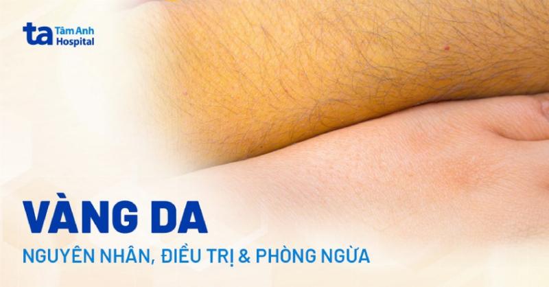 anh-minh-hoa-trieu-chung-da-vang