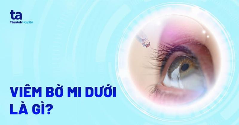 Bệnh nhân đang trao đổi với bác sĩ mắt về tình trạng nổi mụn trắng trên mí mắt, thể hiện sự cần thiết của việc thăm khám chuyên khoa.