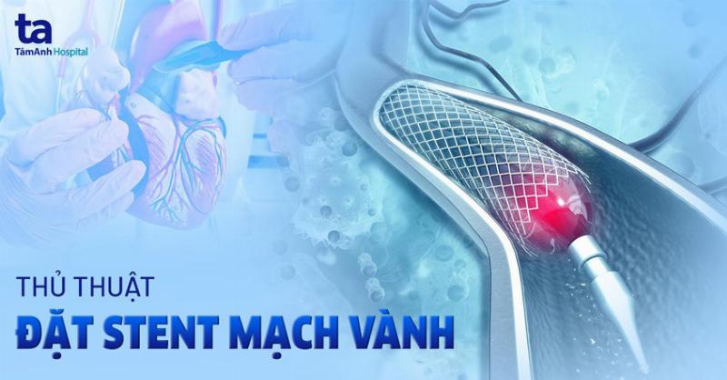 Quy trình can thiệp mạch vành đặt stent để điều trị tắc nghẽn động mạch tim, minh họa cách mở rộng mạch máu