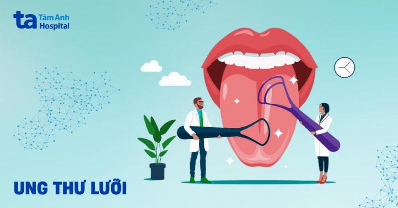 Hình ảnh mô tả các mảng trắng đặc trưng của nấm lưỡi ở người lớn xuất hiện trên lưỡi và má trong