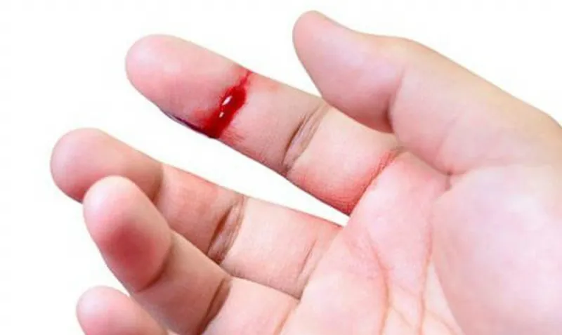 Hướng dẫn cách băng bó vết đứt tay chảy máu đúng cách đảm bảo vệ sinh và an toàn