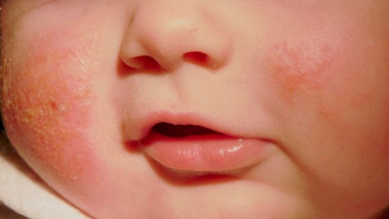 Người mẹ nhẹ nhàng lau mặt cho trẻ sơ sinh bị mụn sữa