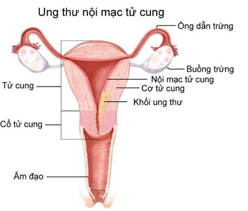 Hình ảnh minh họa một người đang lo lắng hoặc gọi điện thoại, thể hiện sự cần thiết phải tìm kiếm sự giúp đỡ y tế khi các triệu chứng tiểu rắt trở nên nghiêm trọng.
