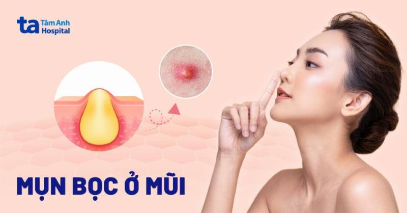 Hình ảnh cận cảnh khuôn mặt trẻ sơ sinh với mụn sữa màu trắng li ti trên mũi và má