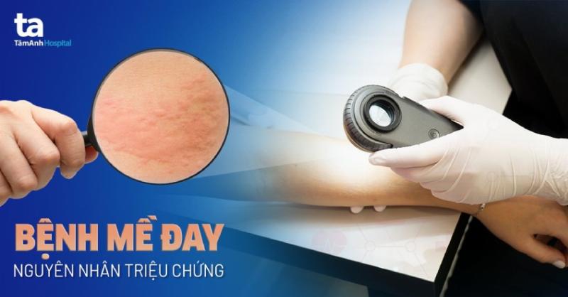 Hình ảnh người bị dị ứng đỏ ngứa ở mặt thể hiện sự khó chịu cần giải pháp
