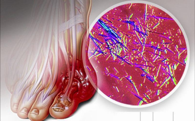Các yếu tố chính gây tăng axit uric máu như ăn uống, rượu bia, bệnh tật
