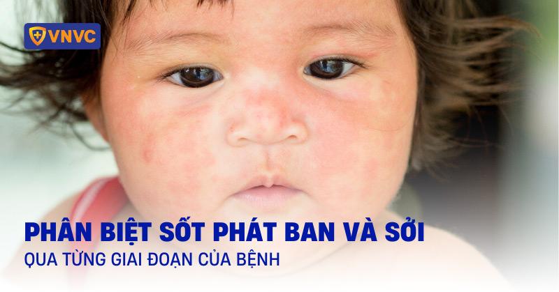 Hình ảnh so sánh các loại phát ban da thường gặp ở trẻ sơ sinh bao gồm mụn sữa